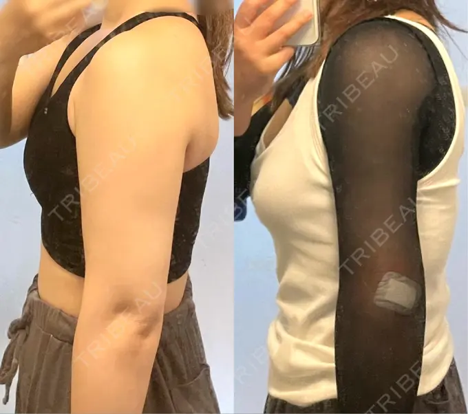 インディバ（肩） / インディバ（二の腕） WOM SALON【術後ケア取扱いサロン】 BEFORE メイン用