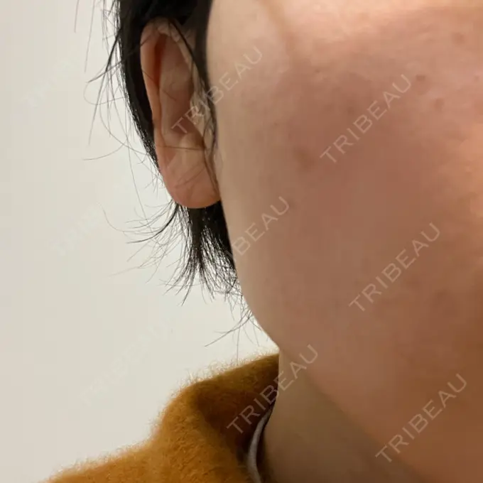 光治療（フォトフェイシャルなど） 銀座TSUBAKIクリニック BEFORE メイン用