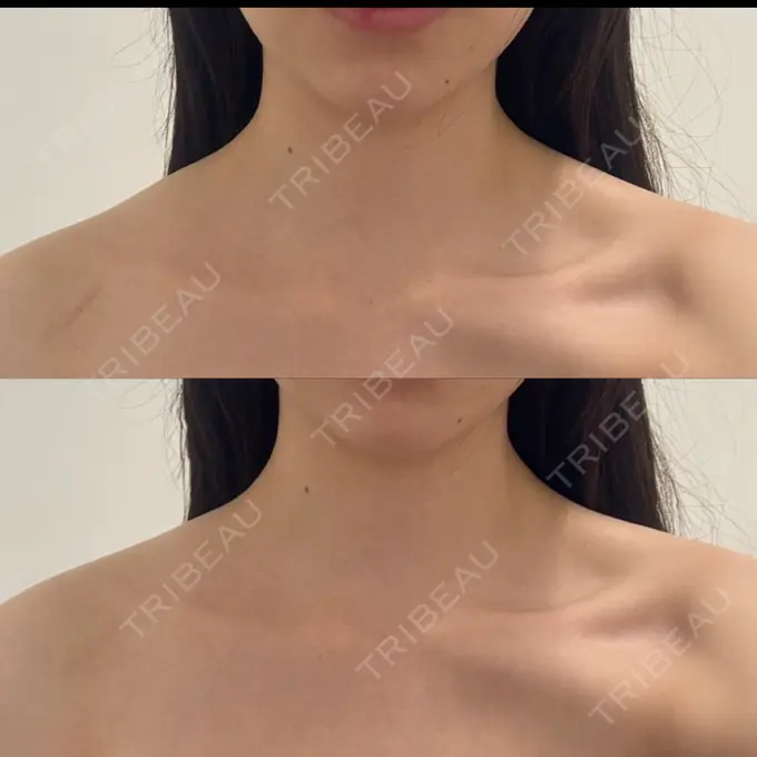 ボトックス（エラ・小顔） DMTC CLINIC 日本橋院 BEFORE メイン用