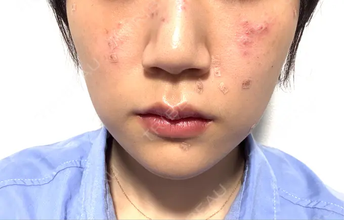 ほくろ・いぼ除去レーザー（肌） / シミ取りレーザー 東京シルククリニック 新宿院 BEFORE メイン用