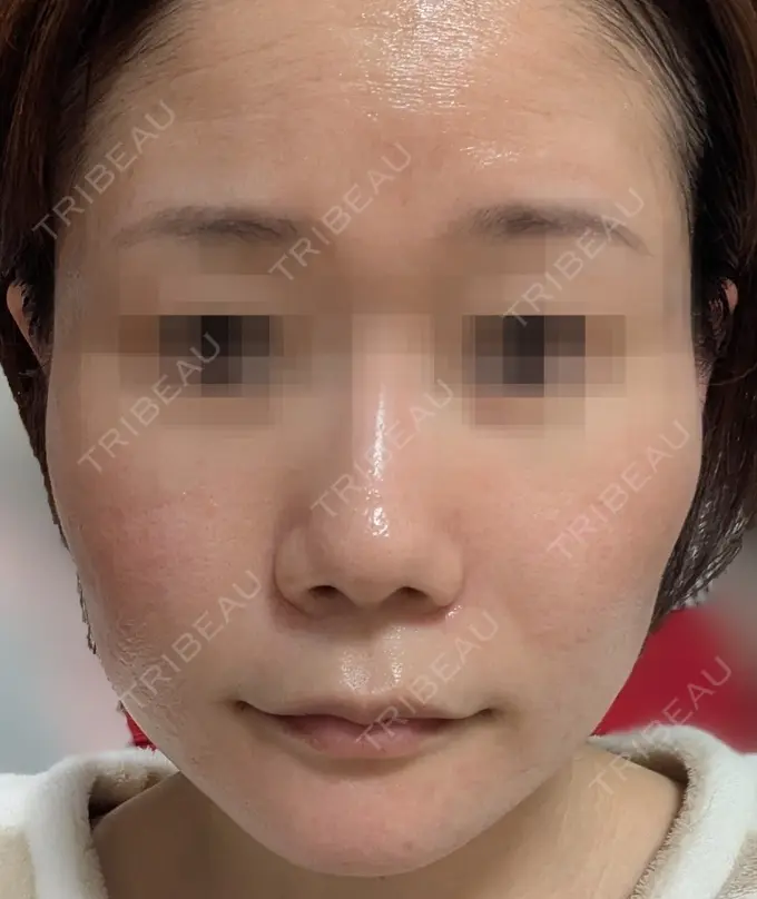 水光注射（ハリ・美肌） / ピーリング（ニキビ・毛穴） / ピーリング（ハリ・ツヤ） DAILY SKIN CLINIC 心斎橋院 BEFORE メイン用