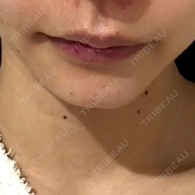 ヒアルロン酸注入（涙袋） / ヒアルロン酸注入（あご） / ヒアルロン酸注入（唇） EMMO FACE CLINIC 東京三田院 BEFORE メイン用