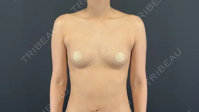 脂肪吸引（二の腕） / 豊胸（脂肪注入） / 脂肪吸引（肩） MYCLI【マイクリ】大阪・梅田院 BEFORE メイン用