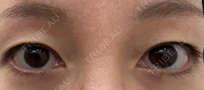 二重埋没 湘南美容クリニック 博多院 BEFORE メイン用