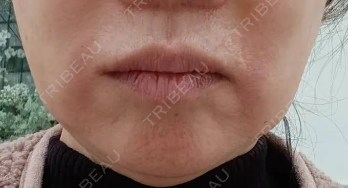 肌ヒアルロン酸注入（たるみ・シワ改善） / ヒアルロン酸注入（唇） AZ BEAUTY CLINIC BEFORE メイン用