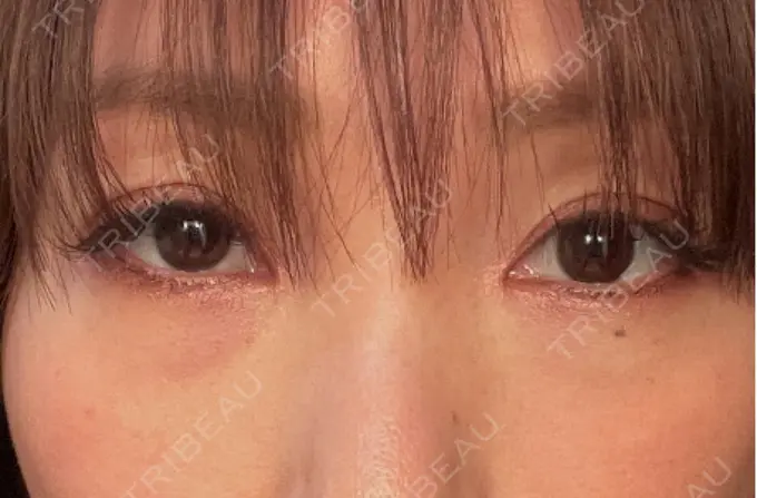 クマ治療 / 下まぶたの脂肪取り ライブリークリニック 浜松町院 BEFORE メイン用