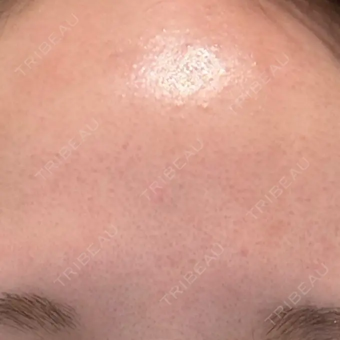 美肌レーザー / 美白レーザー / YAGレーザー / レーザーフェイシャル / 赤み除去レーザー AI Beauty Clinic （エーアイ美容クリニック） BEFORE メイン用