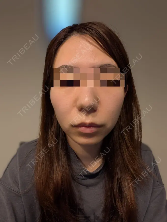 ピーリング（ニキビ・毛穴） Sea Sail Beauty Clinic BEFORE メイン用