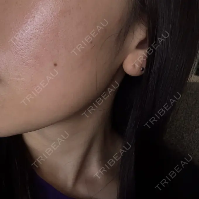 水光注射（ハリ・美肌） / 医療脱毛（顔） 栄美容クリニック 栄院 BEFORE メイン用