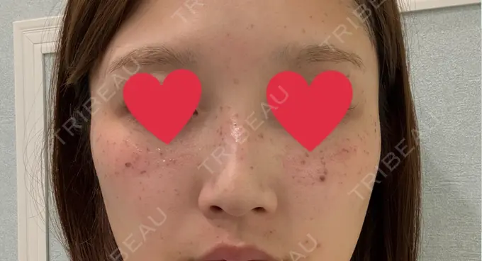 イオン導入 / ルメッカ ルラ美容クリニック 仙台院 / ルラスキンクリニック 仙台院 BEFORE メイン用