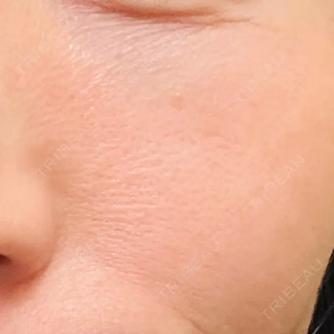 RF（高周波）たるみ治療 湘南美容クリニック 広島院 BEFORE メイン用