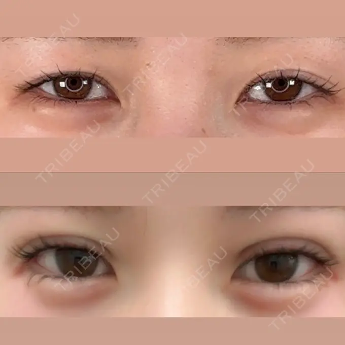 二重埋没 アリエル美容クリニック 水戸院 BEFORE メイン用