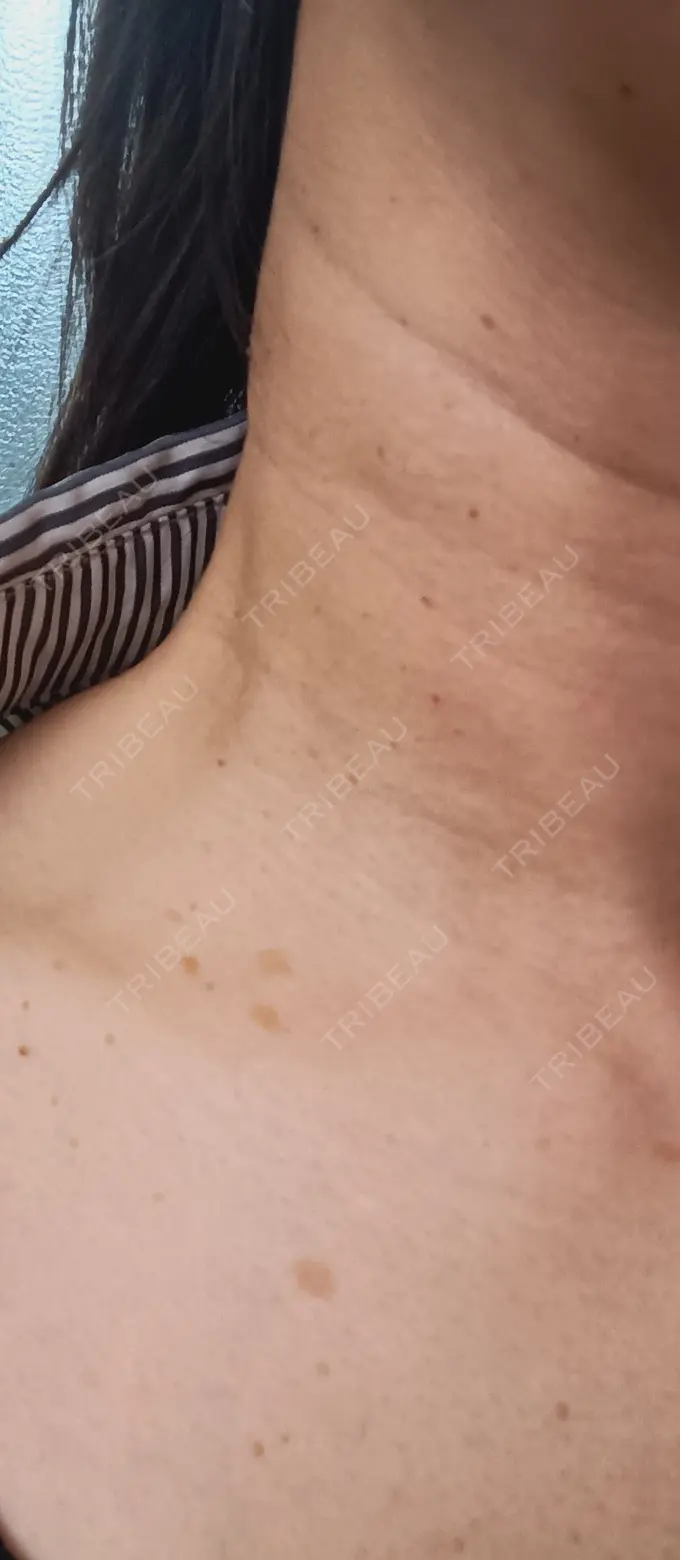 シミ取りレーザー / インモード 東京シルククリニック 新宿院 BEFORE メイン用