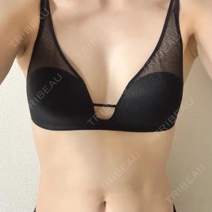 脂肪吸引（脚） / 豊胸（脂肪注入） 湘南美容クリニック Regno 銀座院 BEFORE メイン用