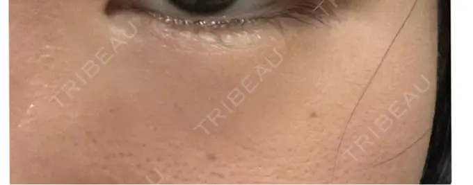 ボトックス（人中） / その他（目元） 東京形成美容外科 船橋院 BEFORE メイン用