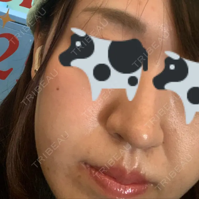 ピーリング（ニキビ・毛穴） / ルメッカ ルラ美容クリニック 千葉院 / ルラスキンクリニック 千葉院 BEFORE メイン用