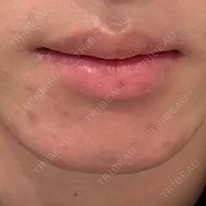 ボトックス（あご） / ヒアルロン酸注入（あご） 大美会クリニック 梅田院 BEFORE メイン用