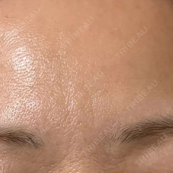 ボトックス（眉間） / ボトックス（目尻） / ボトックス（額） ルヴィクリニック イオンドーム前院 BEFORE メイン用