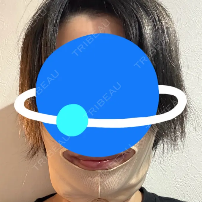 糸リフト / 脂肪吸引（顔） / メーラーファット除去 / ジョールファット除去 東京シンデレラ美容外科 池袋院 BEFORE メイン用