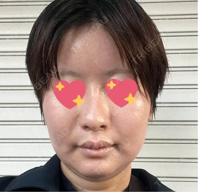 ハイフ（顔） しんゆり美容健康クリニック BEFORE メイン用