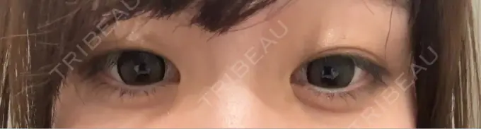 二重埋没 広島プルミエクリニック BEFORE メイン用