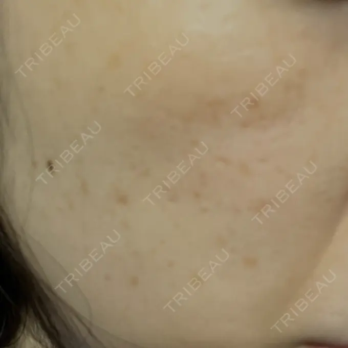 フラクショナルレーザー（毛穴・ニキビ跡） Designo Clinic （デジーノクリニック） BEFORE メイン用