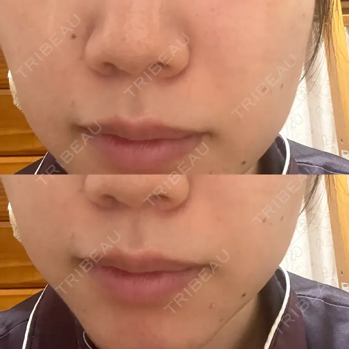 ルメッカ ルラ美容クリニック 千葉院 / ルラスキンクリニック 千葉院 BEFORE メイン用