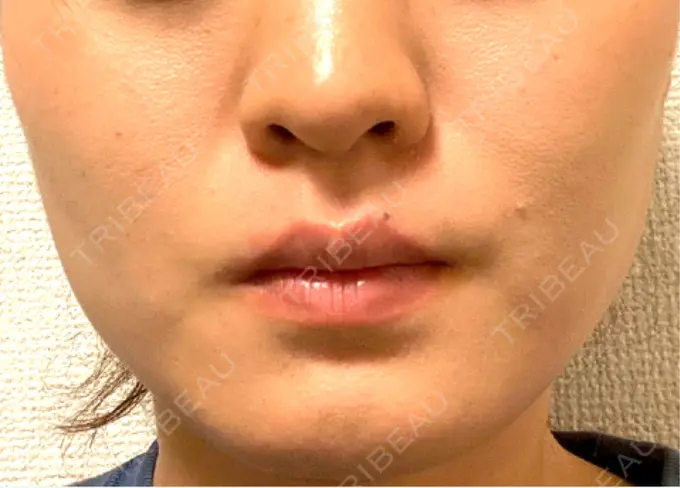 ボトックス（エラ・小顔） 共立美容外科 梅田院 BEFORE メイン用