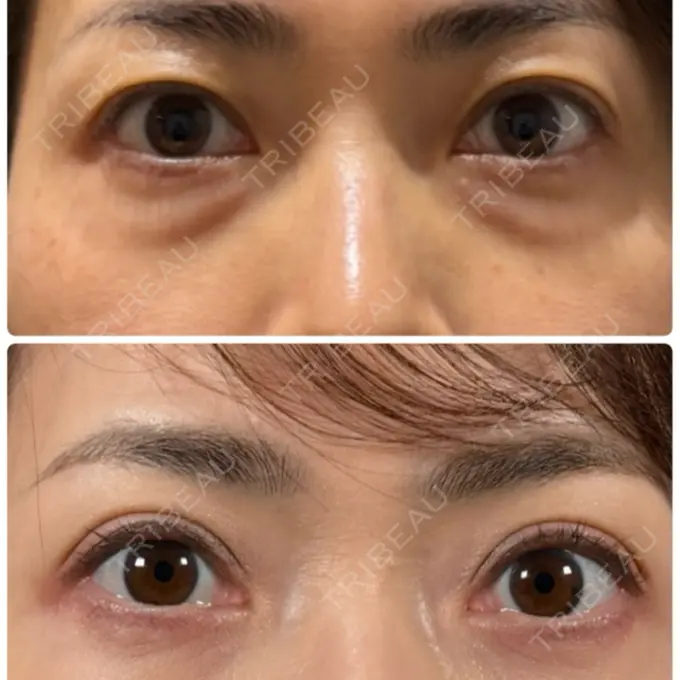 二重埋没 / クマ治療 神戸美容外科 ネビュラクリニック BEFORE メイン用