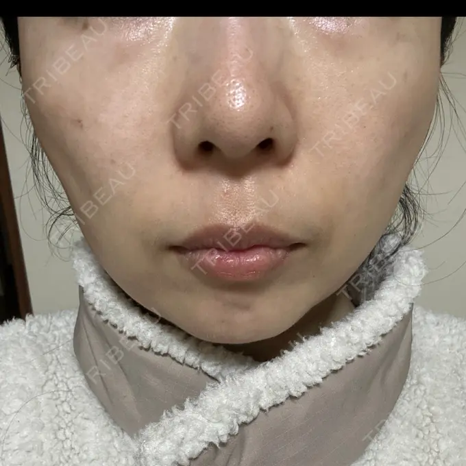 光治療（フォトフェイシャルなど） Sea Sail Beauty Clinic BEFORE メイン用