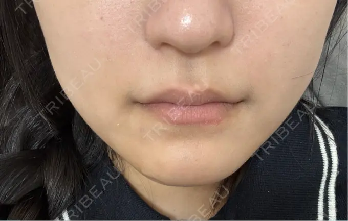 RF（高周波）たるみ治療 / オンダリフト ライブリークリニック 大阪院 BEFORE メイン用