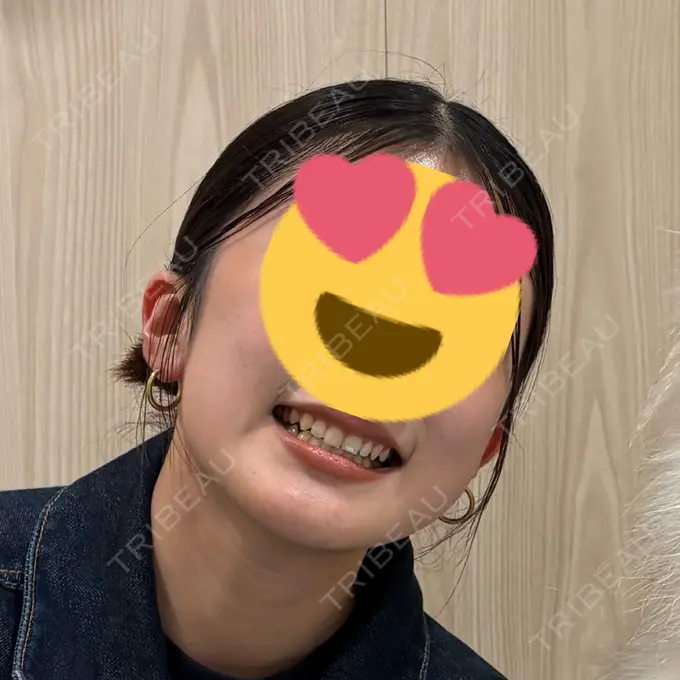 糸リフト / 脂肪吸引（顔） 下北沢スキンクリニック BEFORE メイン用