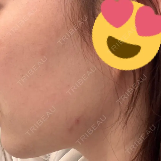 医療脱毛（顔） / 医療脱毛（全身） エスクリニック 恵比寿 BEFORE メイン用