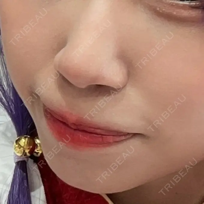 糸リフト / 脂肪吸引（顔） / ジョールファット除去 / ヒアルロン酸注入（あご） 新宿美容外科ネビュラクリニック BEFORE メイン用