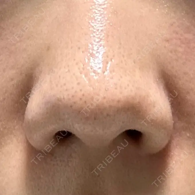 鼻孔縁挙上 シエルクリニック BEFORE メイン用