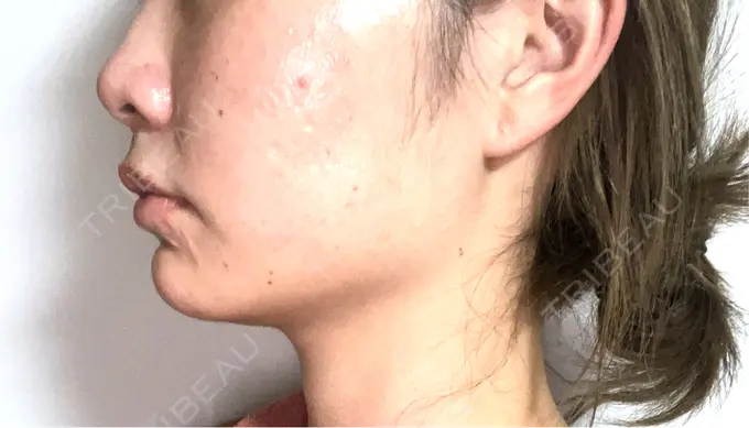 ボトックス（エラ・小顔） TCB東京中央美容外科 那覇院 BEFORE メイン用