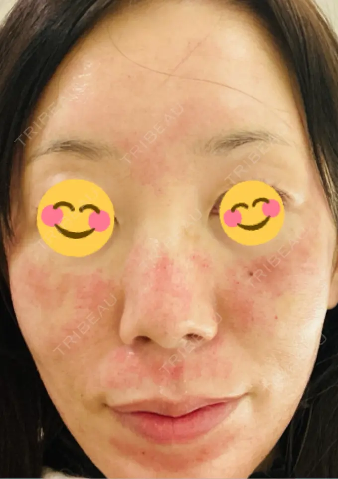 ポテンツァ ルラ美容クリニック 千葉院 / ルラスキンクリニック 千葉院 BEFORE メイン用