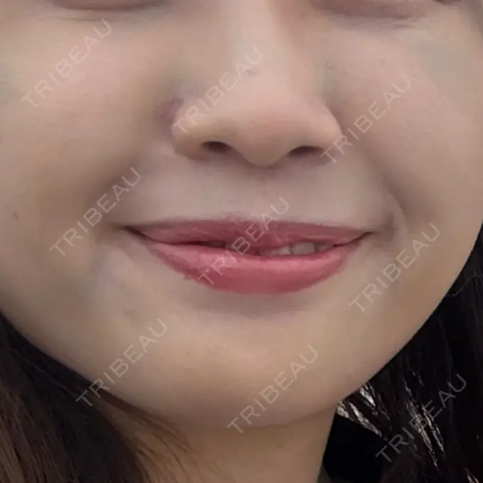 脂肪溶解注射（顔） 日比谷セントラルクリニック BEFORE メイン用