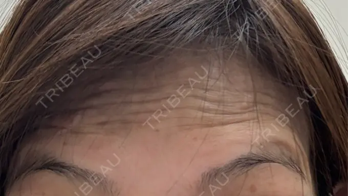 ボトックス（あご） / ボトックス（眉間） / ボトックス（目尻） / ボトックス（額） 湘南美容クリニック 金山院 BEFORE メイン用