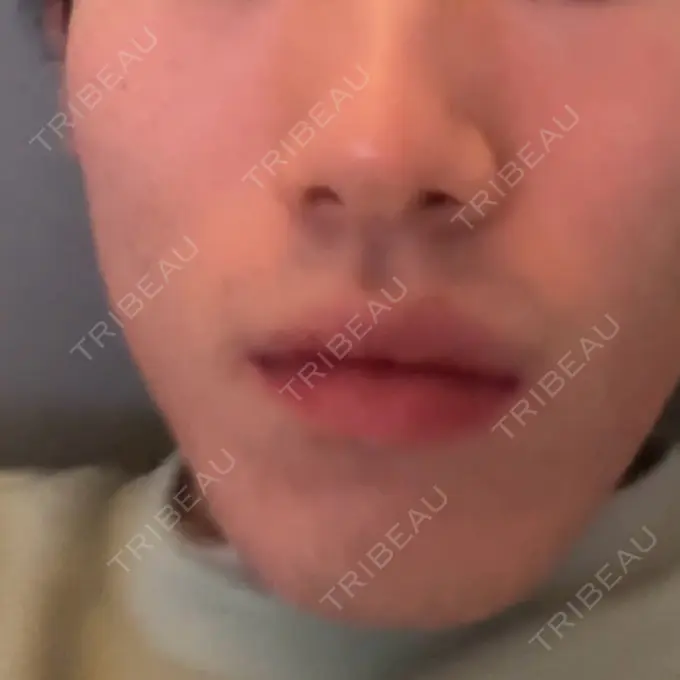 ボトックス（エラ・小顔） DMTC CLINIC 日本橋院 BEFORE メイン用