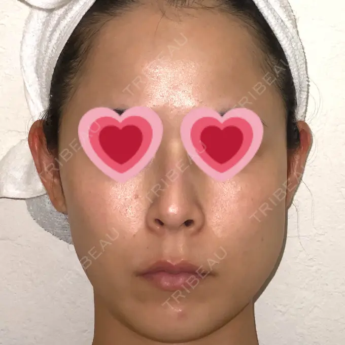 ボトックス（エラ・小顔） もとび美容外科クリニック 新宿院 BEFORE メイン用