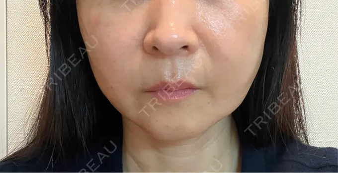 ジャルプロ スマートスキンクリニック 神保町院 BEFORE メイン用