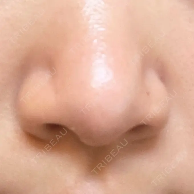 小鼻縮小（切開） OMI CLINIC 【オミクリニック】 BEFORE メイン用