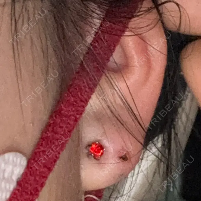 ピアス穴あけ 新宿ラクル美容外科クリニック 六本木院 BEFORE メイン用