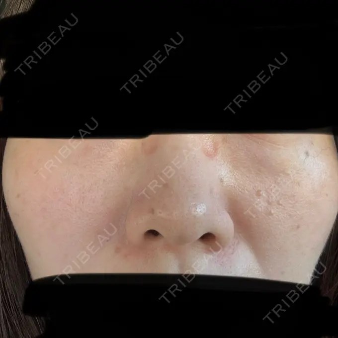 スネコス ルラ美容クリニック 仙台院 / ルラスキンクリニック 仙台院 BEFORE メイン用