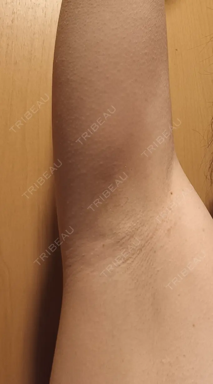 ワキ汗治療（レーザー） フォンタナクリニック天神 BEFORE メイン用