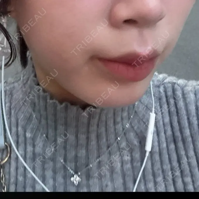 RF（高周波）たるみ治療 大美会クリニック 心斎橋本院 BEFORE メイン用