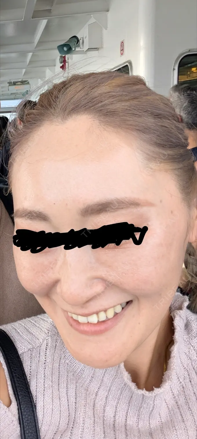 ピコレーザートーニング（美白・肝斑） / ピコフラクショナルレーザー（毛穴・ニキビ跡） / ピコスポット 東京シルククリニック 東京神田院 BEFORE メイン用