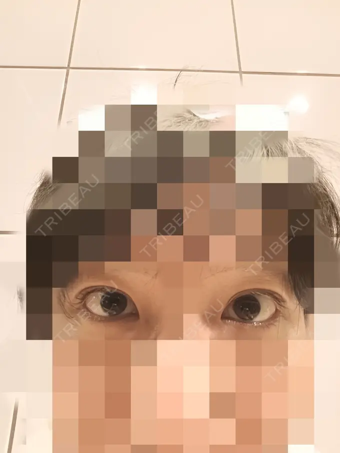 目元修正 もとび美容外科クリニック 新宿院 BEFORE メイン用