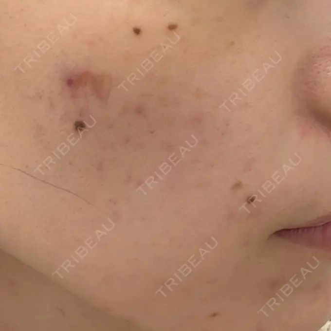 肌育注射（ジュベルックなど） DMTC CLINIC 日本橋院 BEFORE メイン用